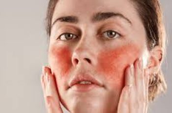 Effective Skincare Solutions for Soothing and Managing Rosacea