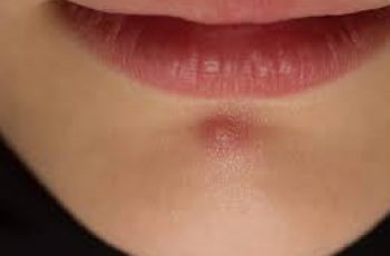 Blind Pimples: Smart Skin Care to Beat Deep Breakouts