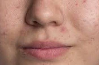 Causes and Effective Treatments for Rough, Bumpy Skin Texture