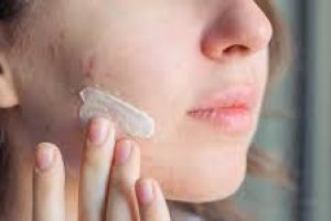 Salicylic Acid and Acne: Skincare Truths You Should Know